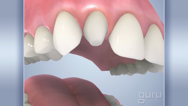 Veneer Malformed Tooth